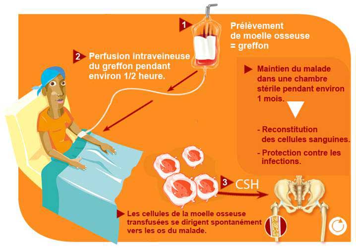 âge Limite Pour Recevoir Une Greffe De Moelle Osseuse 1 - 2